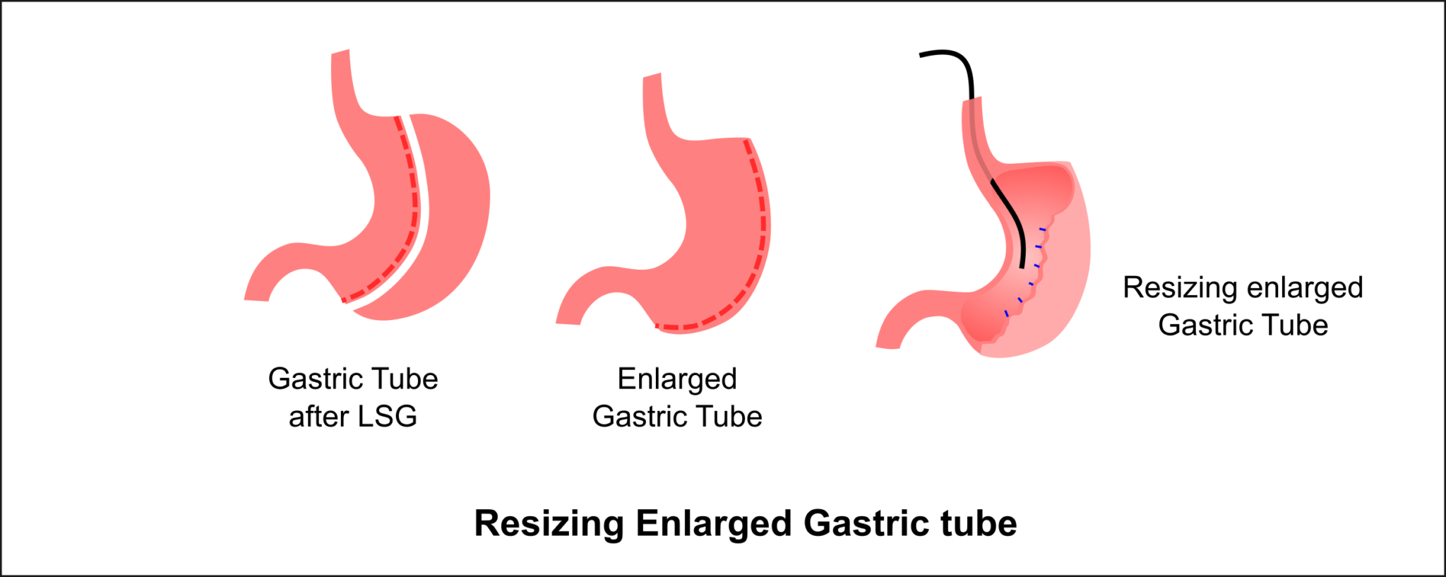 Best Endoscopic Sleeve Gastroplasty Surgery in Bangalore TODS