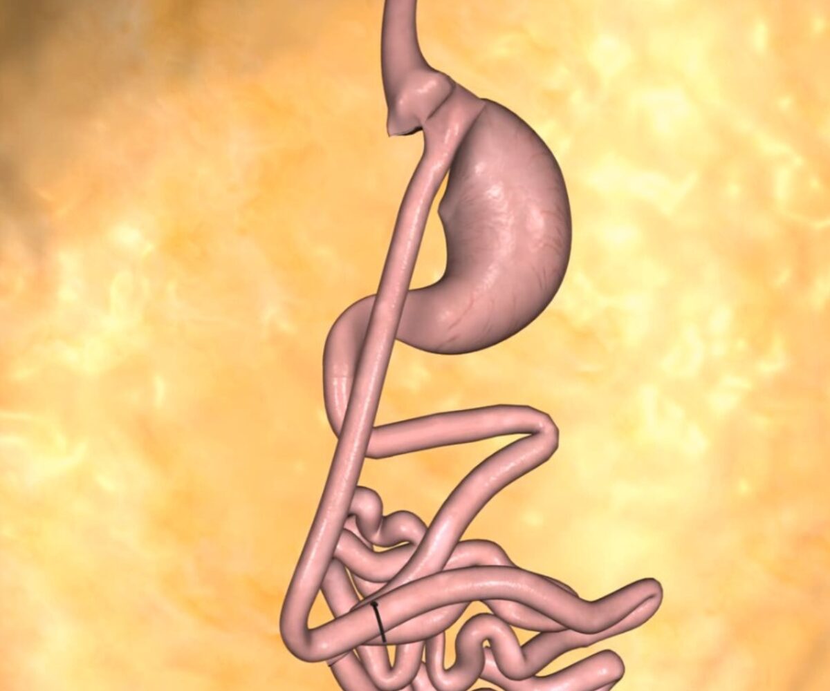 Gastric bypass
